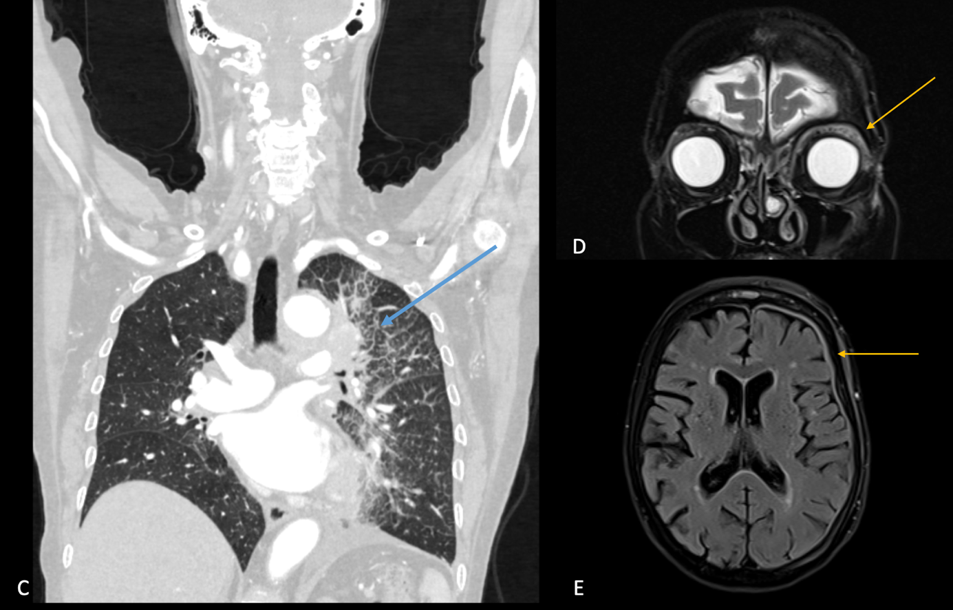 Radiologische Befunde CDE.png